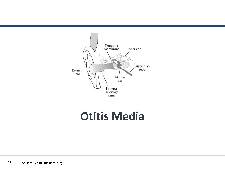 Otitis Media 28 Source: Health Data Consulting 