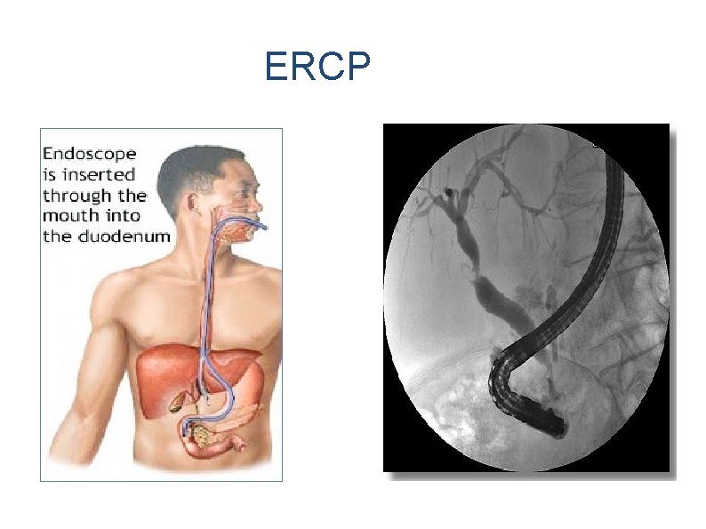 ERCP 