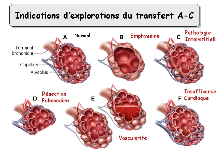 Indications d’explorations du transfert A-C Normal Emphysème Pathologie Interstitielle Insuffisance Cardiaque Résection Pulmonaire Vascularite