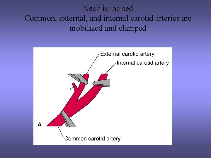 Neck is incised Common, external, and internal carotid arteries are mobilized and clamped 
