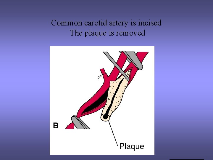 Common carotid artery is incised The plaque is removed 