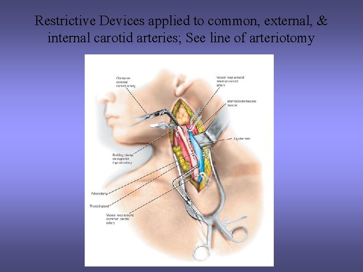 Restrictive Devices applied to common, external, & internal carotid arteries; See line of arteriotomy