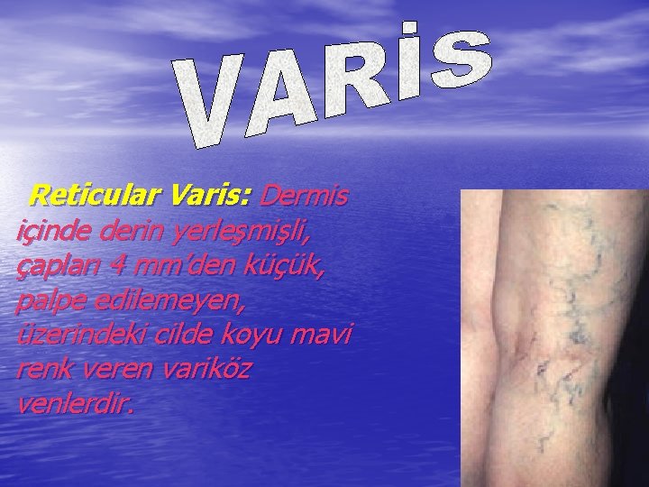 Reticular Varis: Dermis içinde derin yerleşmişli, çapları 4 mm’den küçük, palpe edilemeyen, üzerindeki cilde