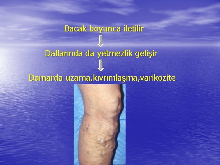 Bacak boyunca iletilir Dallarında da yetmezlik gelişir Damarda uzama, kıvrımlaşma, varikozite 