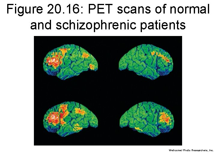 Figure 20. 16: PET scans of normal and schizophrenic patients Wellcome/ Photo Researchers, Inc.