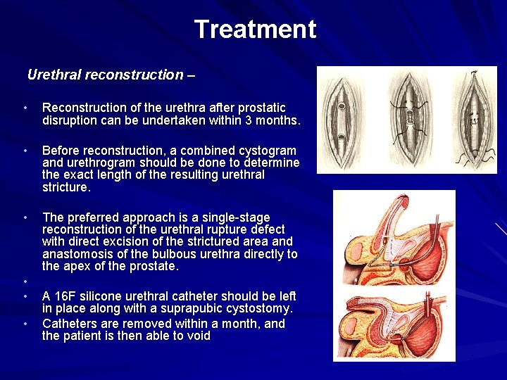 Treatment Urethral reconstruction – • Reconstruction of the urethra after prostatic disruption can be