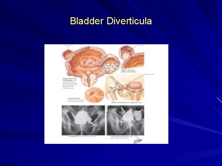 Bladder Diverticula 