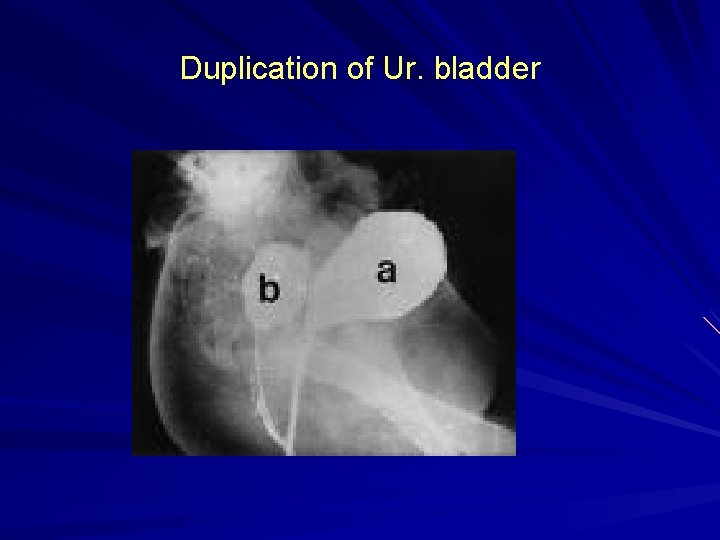 Duplication of Ur. bladder 