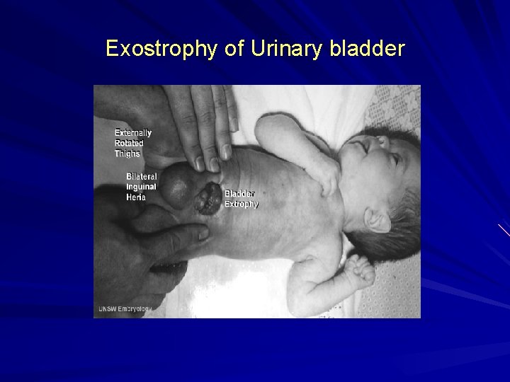 Exostrophy of Urinary bladder 