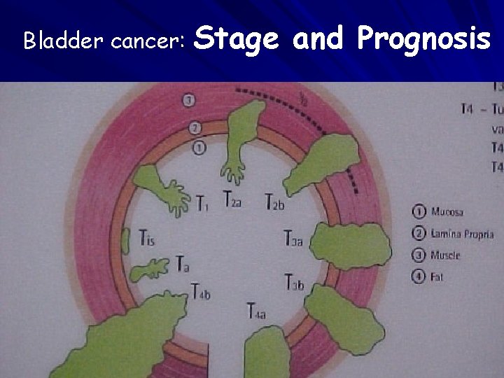 Bladder cancer: Stage and Prognosis 