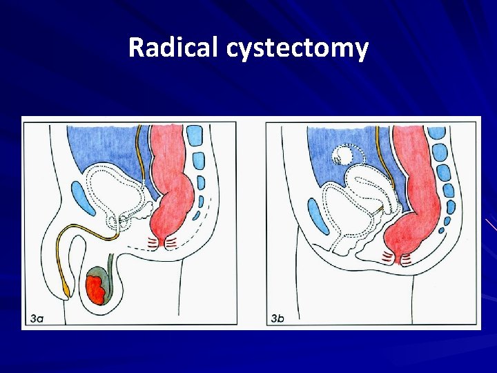 Radical cystectomy 