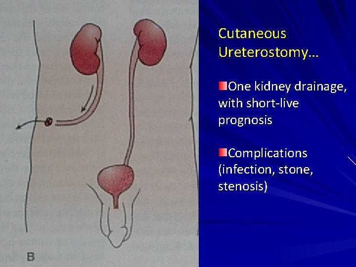 Cutaneous Ureterostomy… One kidney drainage, with short-live prognosis Complications (infection, stone, stenosis) 