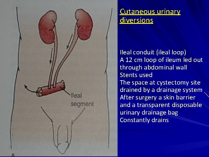 Cutaneous urinary diversions Ileal conduit (ileal loop) A 12 cm loop of ileum led