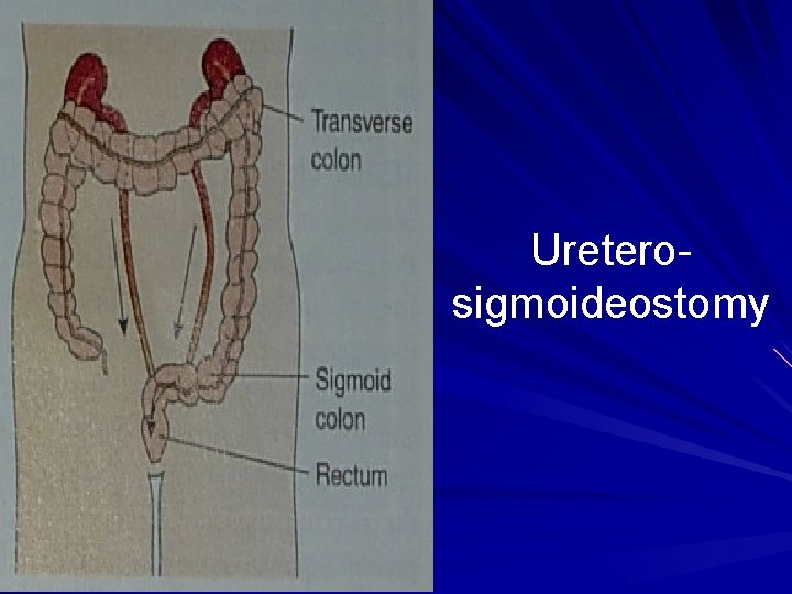 Ureterosigmoideostomy 