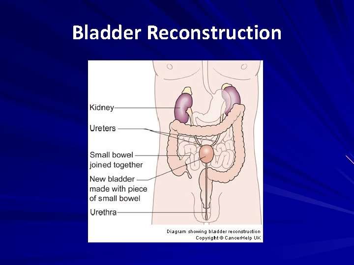 Bladder Reconstruction 