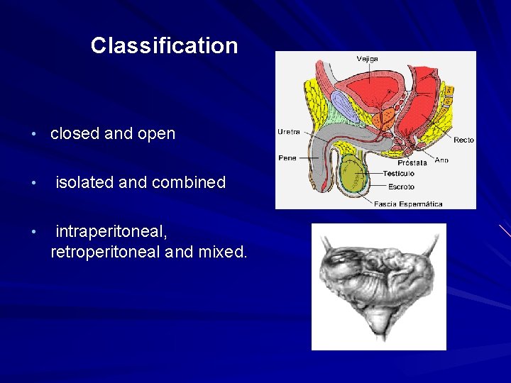 Classification • closed and open • • isolated and combined intraperitoneal, retroperitoneal and mixed.