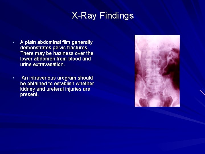 X-Ray Findings • A plain abdominal film generally demonstrates pelvic fractures. There may be