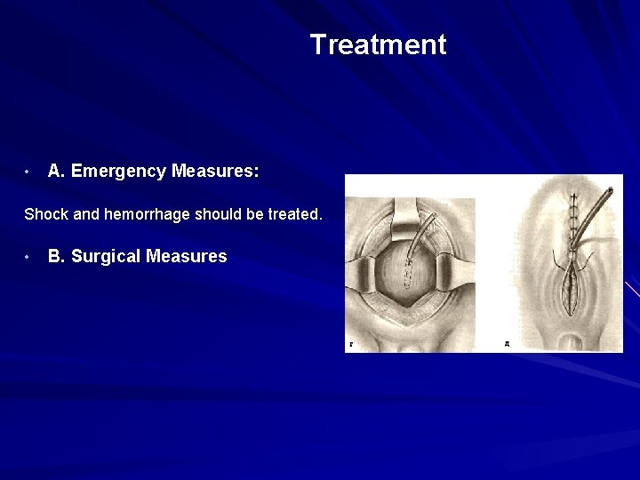 Treatment • A. Emergency Measures: Shock and hemorrhage should be treated. • B. Surgical