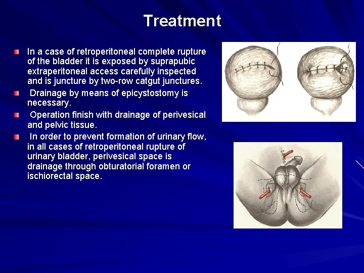 Treatment In a case of retroperitoneal complete rupture of the bladder it is exposed