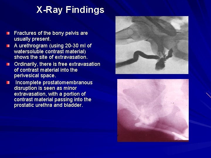 X-Ray Findings Fractures of the bony pelvis are usually present. A urethrogram (using 20