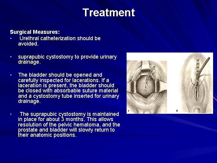 Treatment Surgical Measures: • Urethral catheterization should be avoided. • suprapubic cystostomy to provide