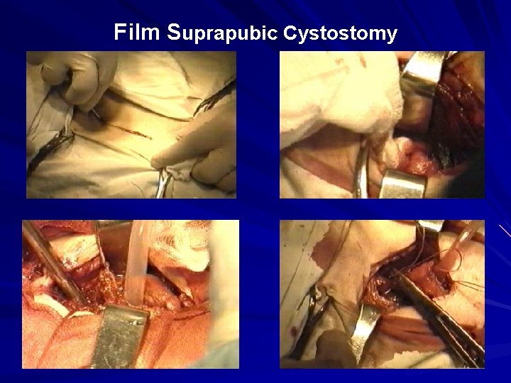 Film Suprapubic Cystostomy 