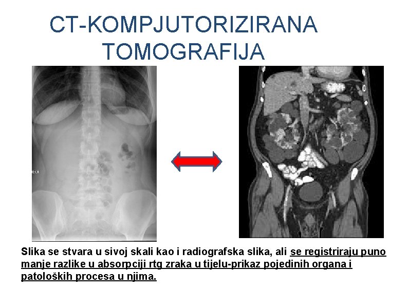 CT-KOMPJUTORIZIRANA TOMOGRAFIJA Slika se stvara u sivoj skali kao i radiografska slika, ali se CT-KOMPJUTORIZIRANA TOMOGRAFIJA Slika se stvara u sivoj skali kao i radiografska slika, ali se