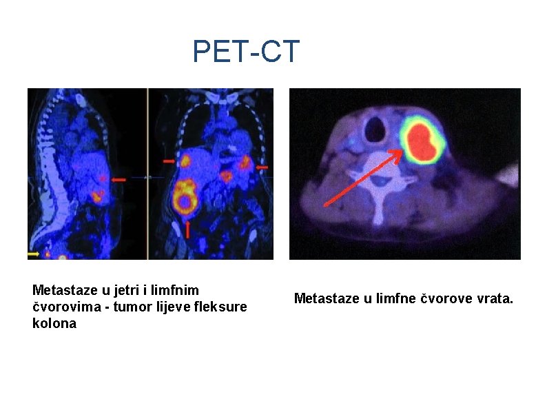PET-CT Metastaze u jetri i limfnim čvorovima - tumor lijeve fleksure kolona Metastaze u PET-CT Metastaze u jetri i limfnim čvorovima - tumor lijeve fleksure kolona Metastaze u