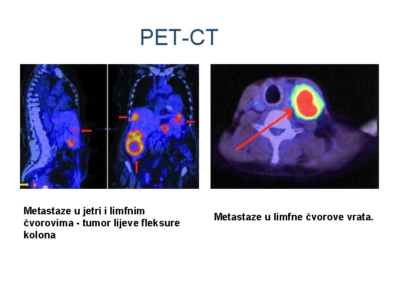 PET-CT Metastaze u jetri i limfnim čvorovima - tumor lijeve fleksure kolona Metastaze u