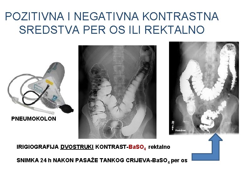 POZITIVNA I NEGATIVNA KONTRASTNA SREDSTVA PER OS ILI REKTALNO PNEUMOKOLON IRIGIOGRAFIJA DVOSTRUKI KONTRAST-Ba. SO