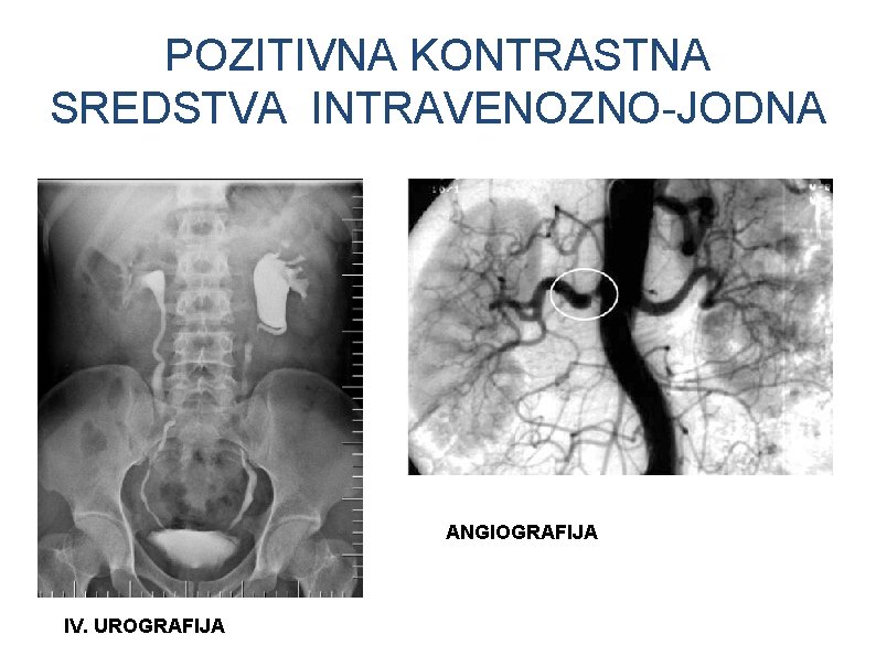 POZITIVNA KONTRASTNA SREDSTVA INTRAVENOZNO-JODNA ANGIOGRAFIJA IV. UROGRAFIJA POZITIVNA KONTRASTNA SREDSTVA INTRAVENOZNO-JODNA ANGIOGRAFIJA IV. UROGRAFIJA