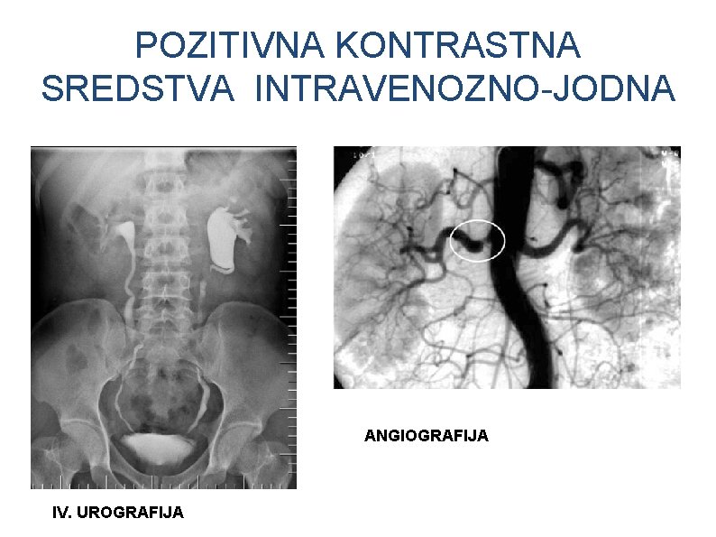 POZITIVNA KONTRASTNA SREDSTVA INTRAVENOZNO-JODNA ANGIOGRAFIJA IV. UROGRAFIJA 