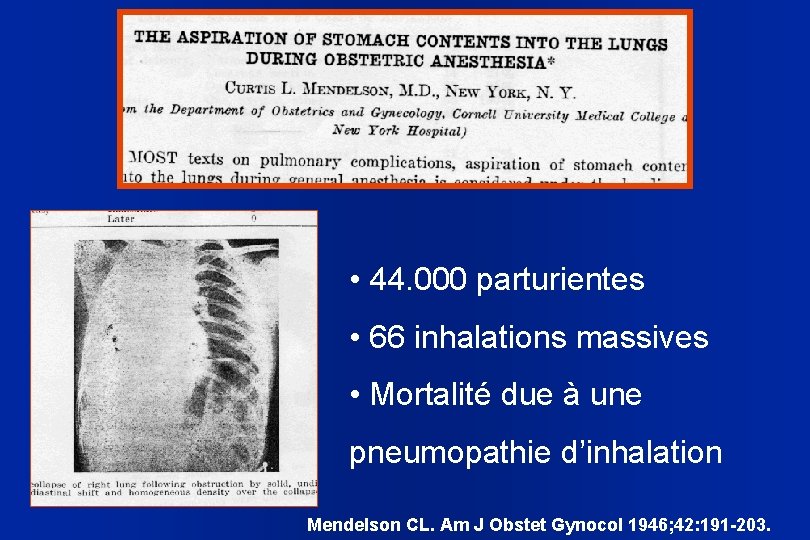  • 44. 000 parturientes • 66 inhalations massives • Mortalité due à une