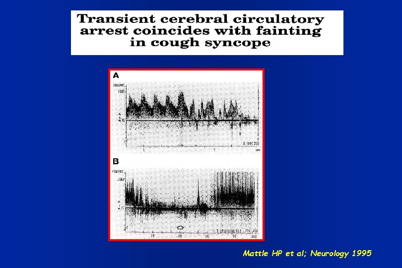 Mattle HP et al; Neurology 1995 