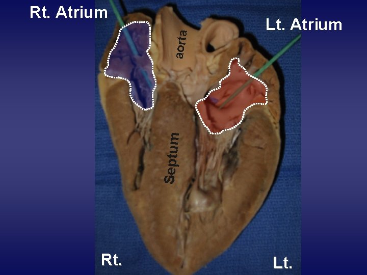 Lt. Atrium Septum aorta Rt. Atrium Rt. Lt. 