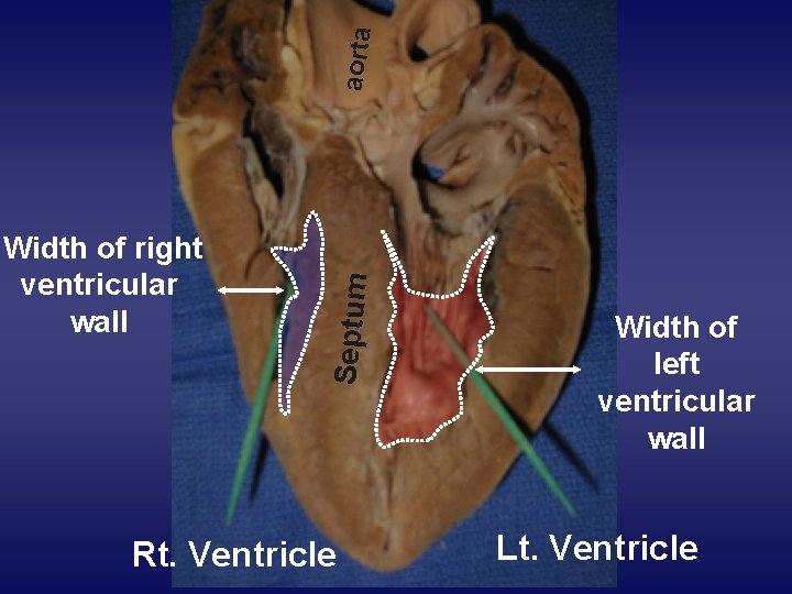 aorta Septum Width of right ventricular wall Rt. Ventricle Width of left ventricular wall