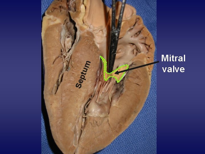 Sep tum Mitral valve 