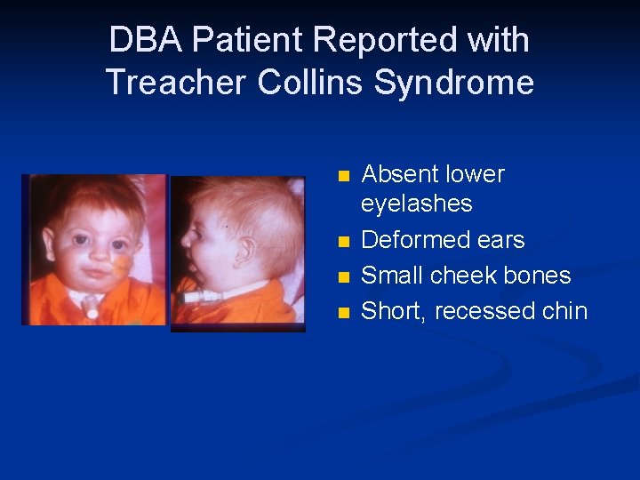 DBA Patient Reported with Treacher Collins Syndrome n n Absent lower eyelashes Deformed ears