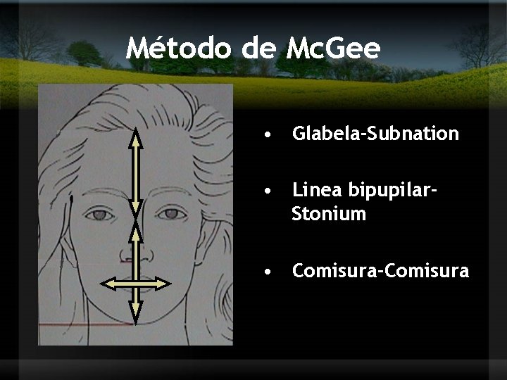 Método de Mc. Gee • Glabela-Subnation • Linea bipupilar. Stonium • Comisura-Comisura 