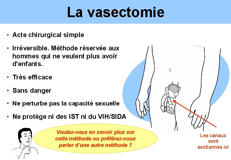 La vasectomie • Acte chirurgical simple • Irréversible. Méthode réservée aux hommes qui ne