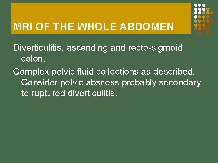 MRI OF THE WHOLE ABDOMEN Diverticulitis, ascending and recto-sigmoid colon. Complex pelvic fluid collections