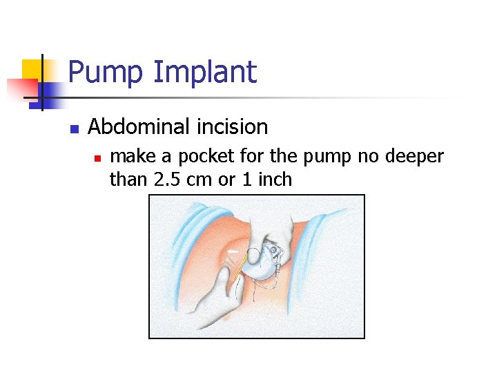 Pump Implant n Abdominal incision n make a pocket for the pump no deeper