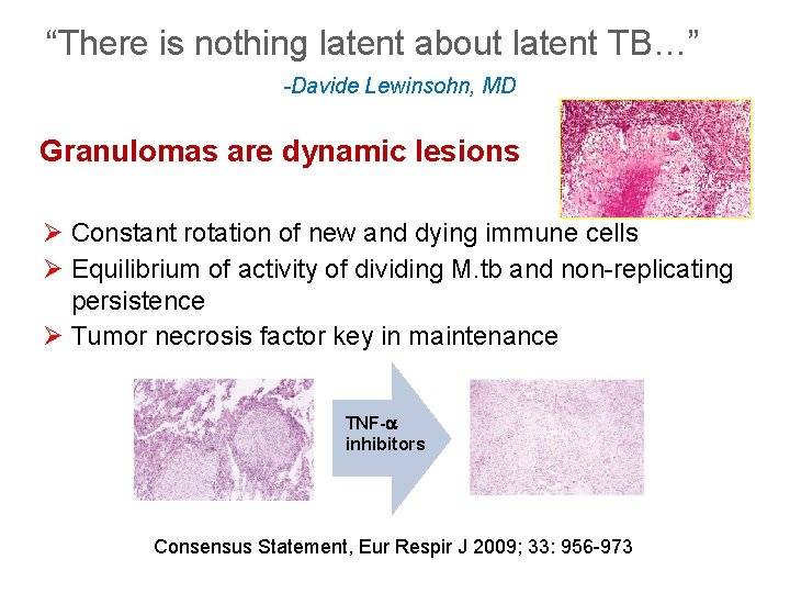 “There is nothing latent about latent TB…” -Davide Lewinsohn, MD Granulomas are dynamic lesions
