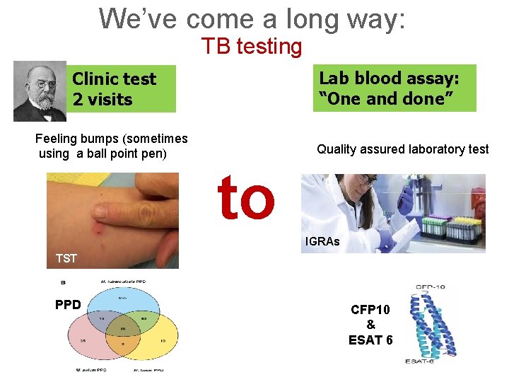 We’ve come a long way: TB testing Lab blood assay: “One and done” Clinic