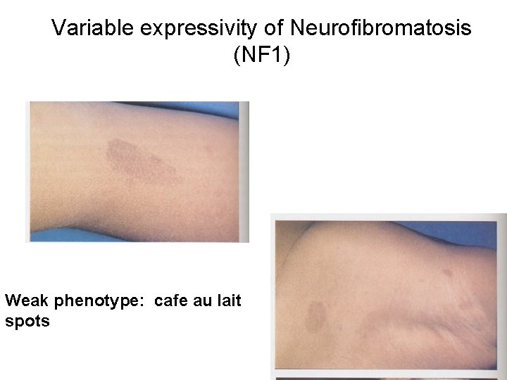 Variable expressivity of Neurofibromatosis (NF 1) Weak phenotype: cafe au lait spots 