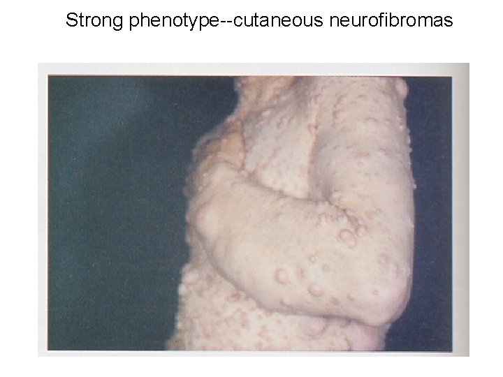 Strong phenotype--cutaneous neurofibromas 