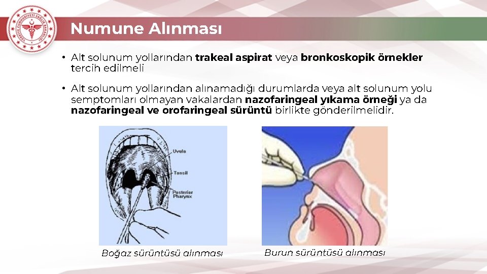 Numune Alınması • Alt solunum yollarından trakeal aspirat veya bronkoskopik örnekler tercih edilmeli •