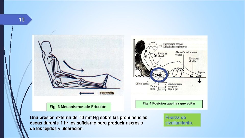 10 Una presión externa de 70 mm. Hg sobre las prominencias óseas durante 1