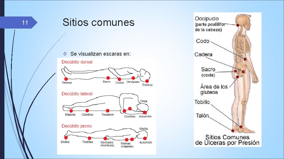 11 Sitios comunes Se visualizan escaras en: 