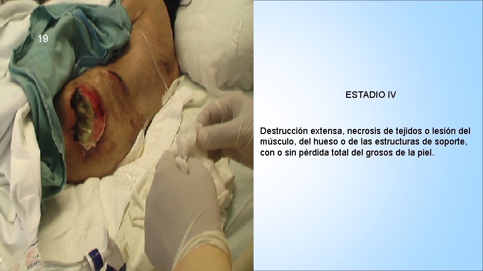 19 ESTADIO IV Destrucción extensa, necrosis de tejidos o lesión del músculo, del hueso